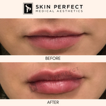HA Fillers BABE Sale