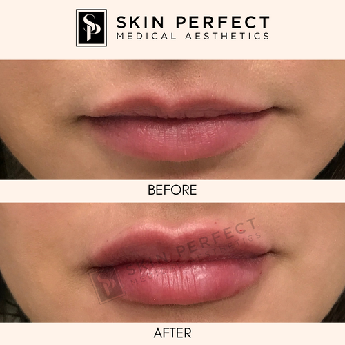 HA Fillers BABE Sale