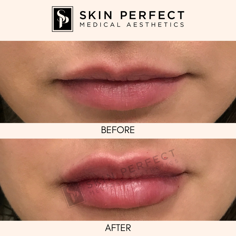 HA Fillers BABE Sale