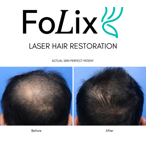 FoLix Laser Hair Regeneration