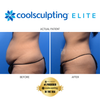 CoolSculpting Elite Black Friday Sale