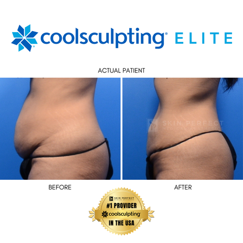 CoolSculpting Elite Black Friday Sale