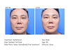 Hidrafacial