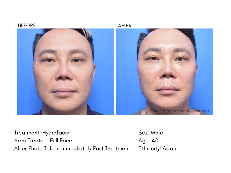 HydraFacial