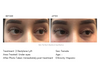 restylane-lyft-undereyes-female-1