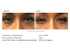 restylane-lyft-undereyes-female-2