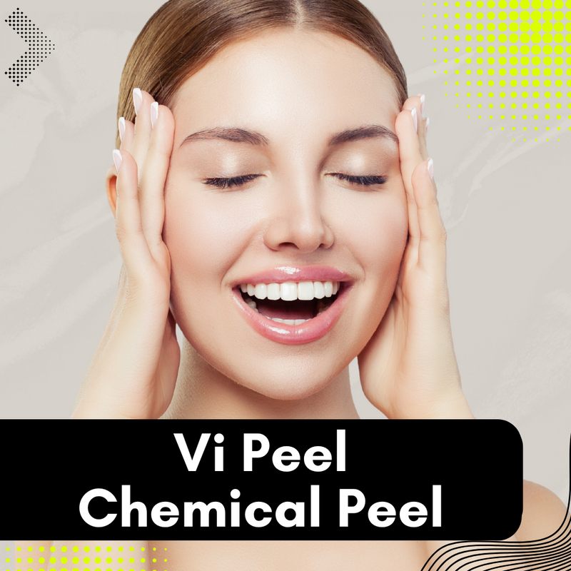 Vi Peel - Chemical Peel