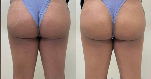 Body Injectables