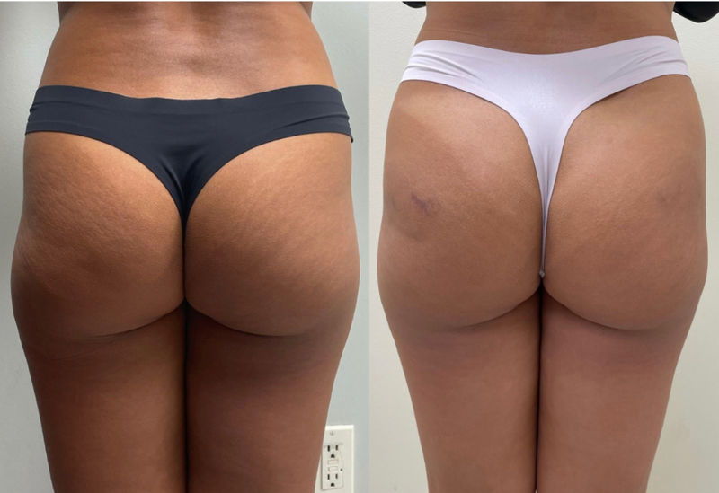 Body Injectables
